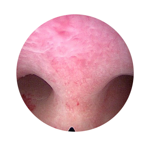 tabiques uterinos dos - Histeroscopia